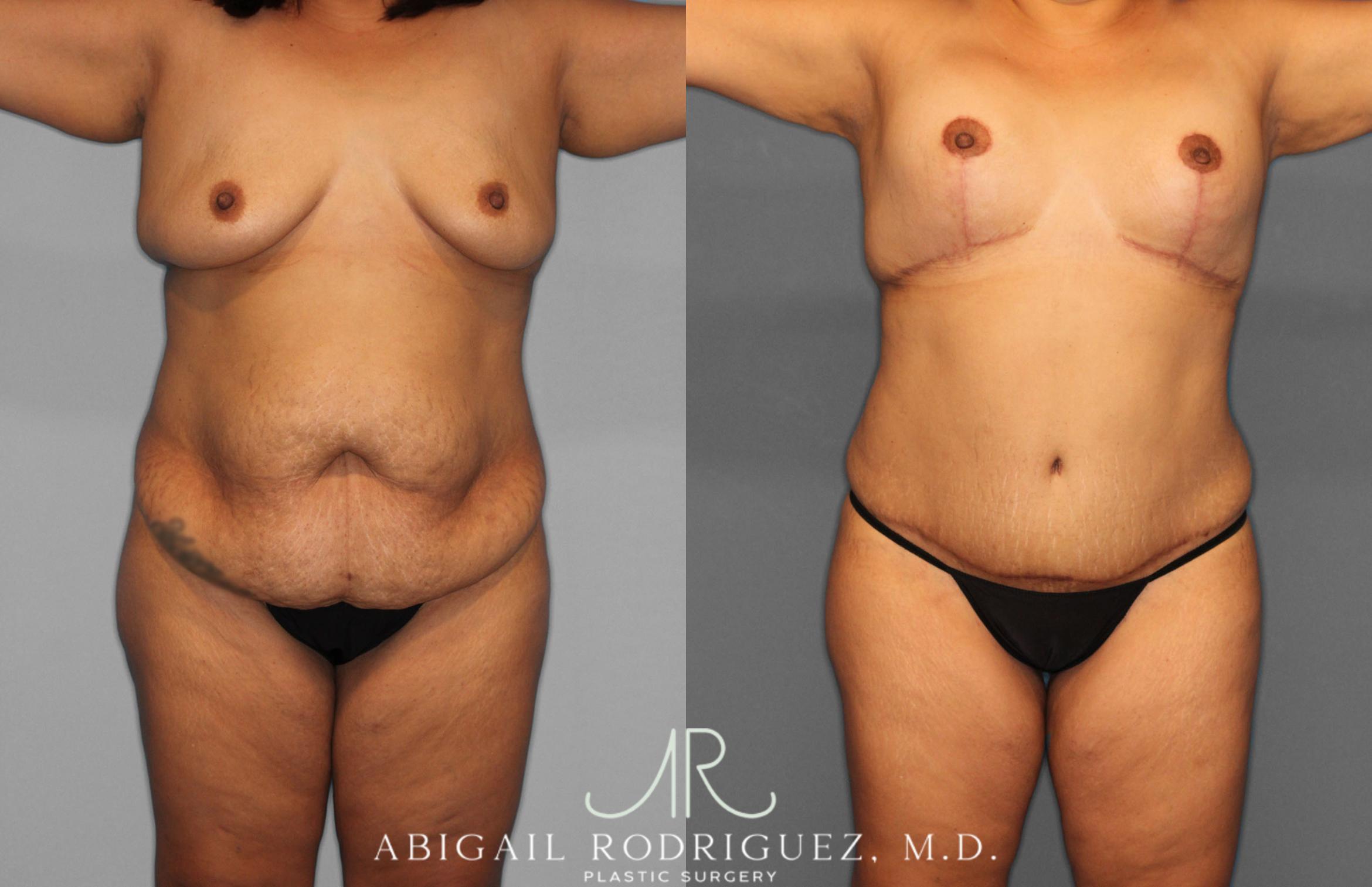 Before & After Tummy Tuck Case 257400 View 1 View in Houston, TX