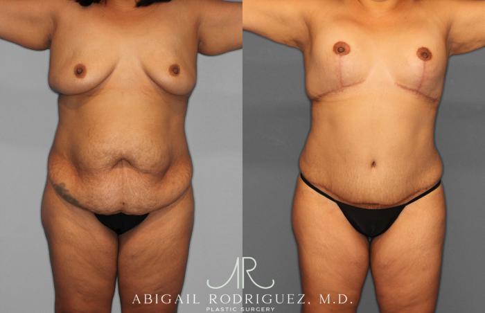 Before & After Breast Lift Case 257400 View 1 View in Houston, TX