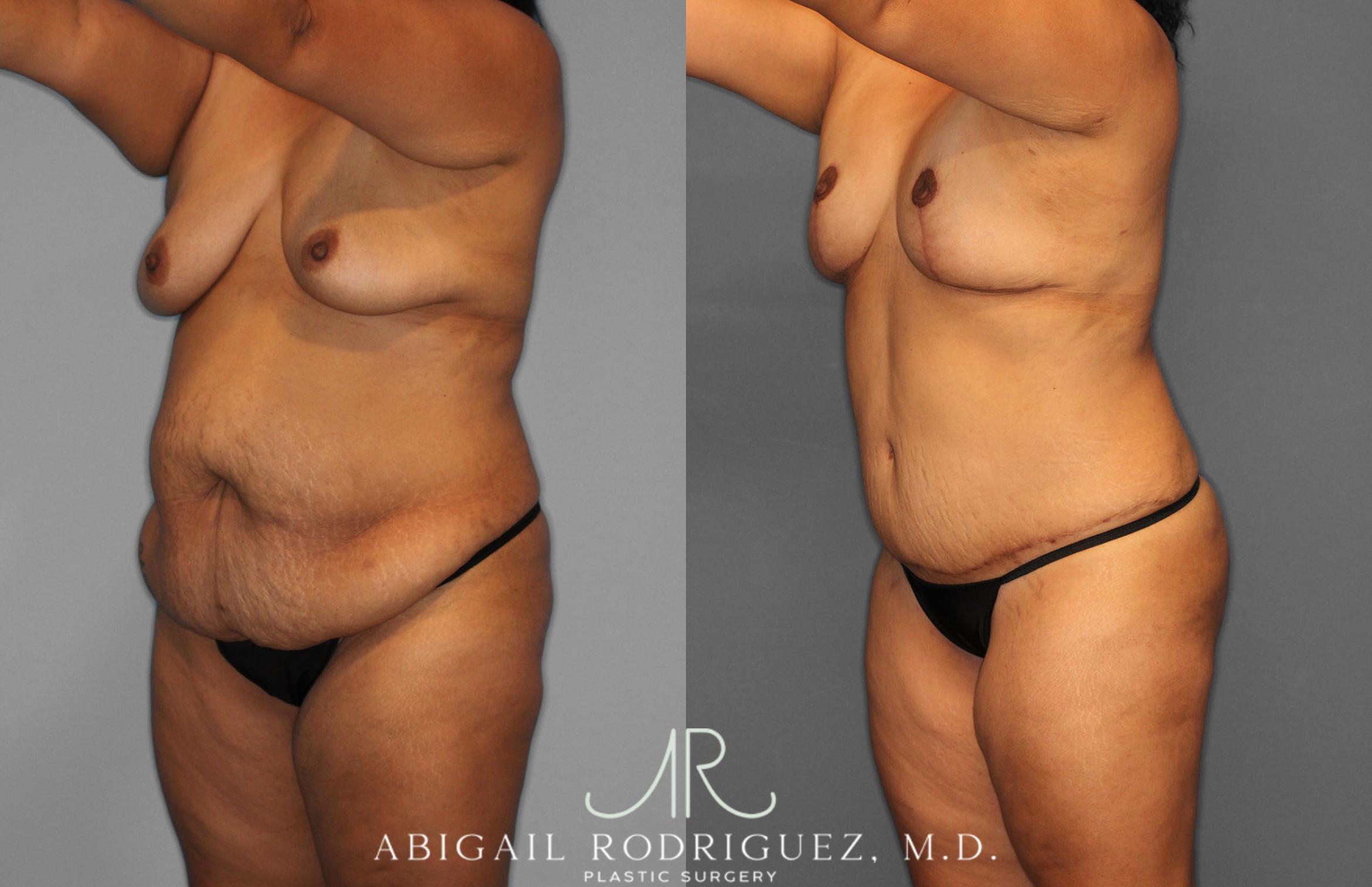 Before & After Tummy Tuck Case 257400 View 2 View in Houston, TX