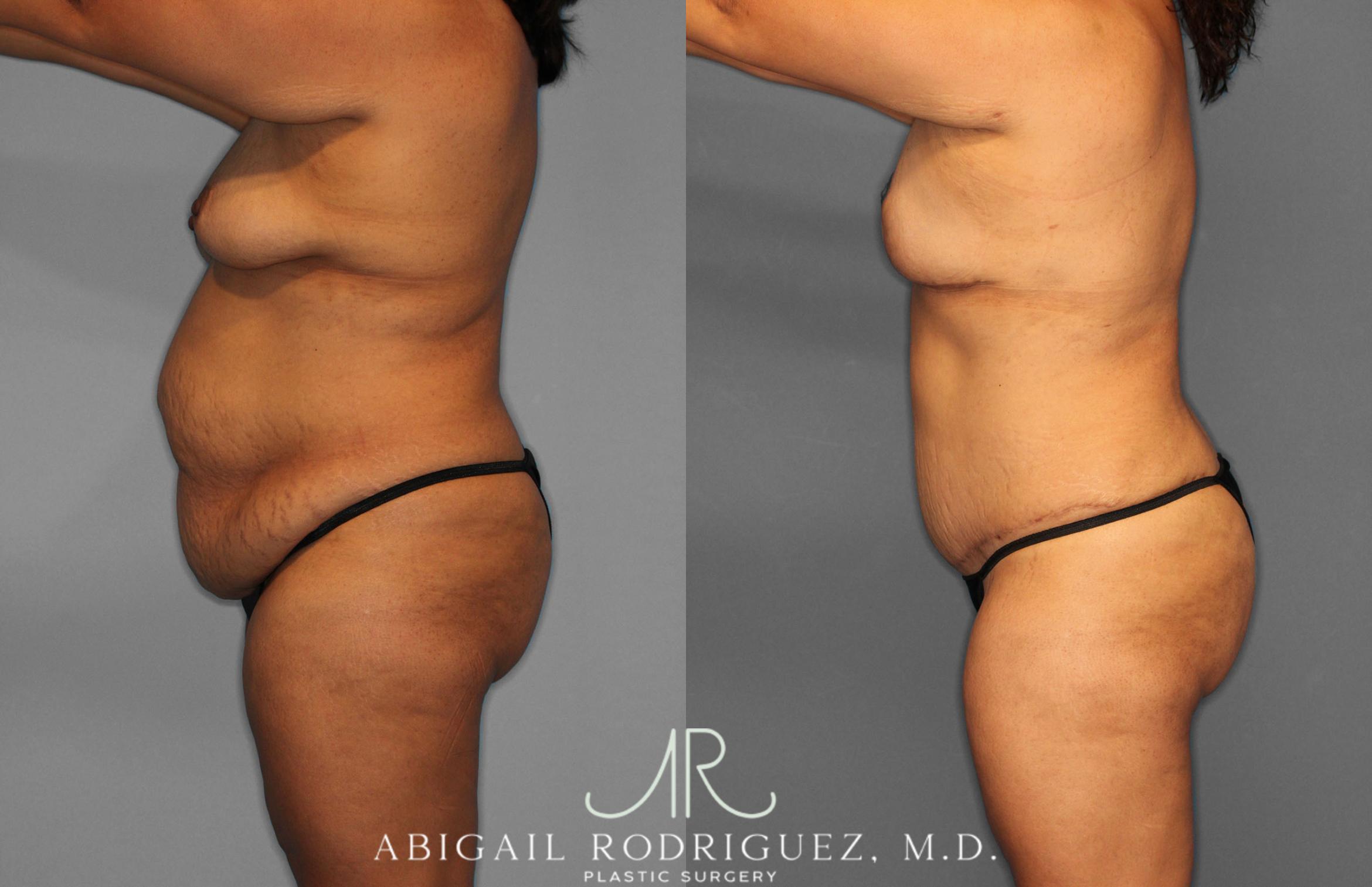 Before & After Tummy Tuck Case 257400 View 3 View in Houston, TX