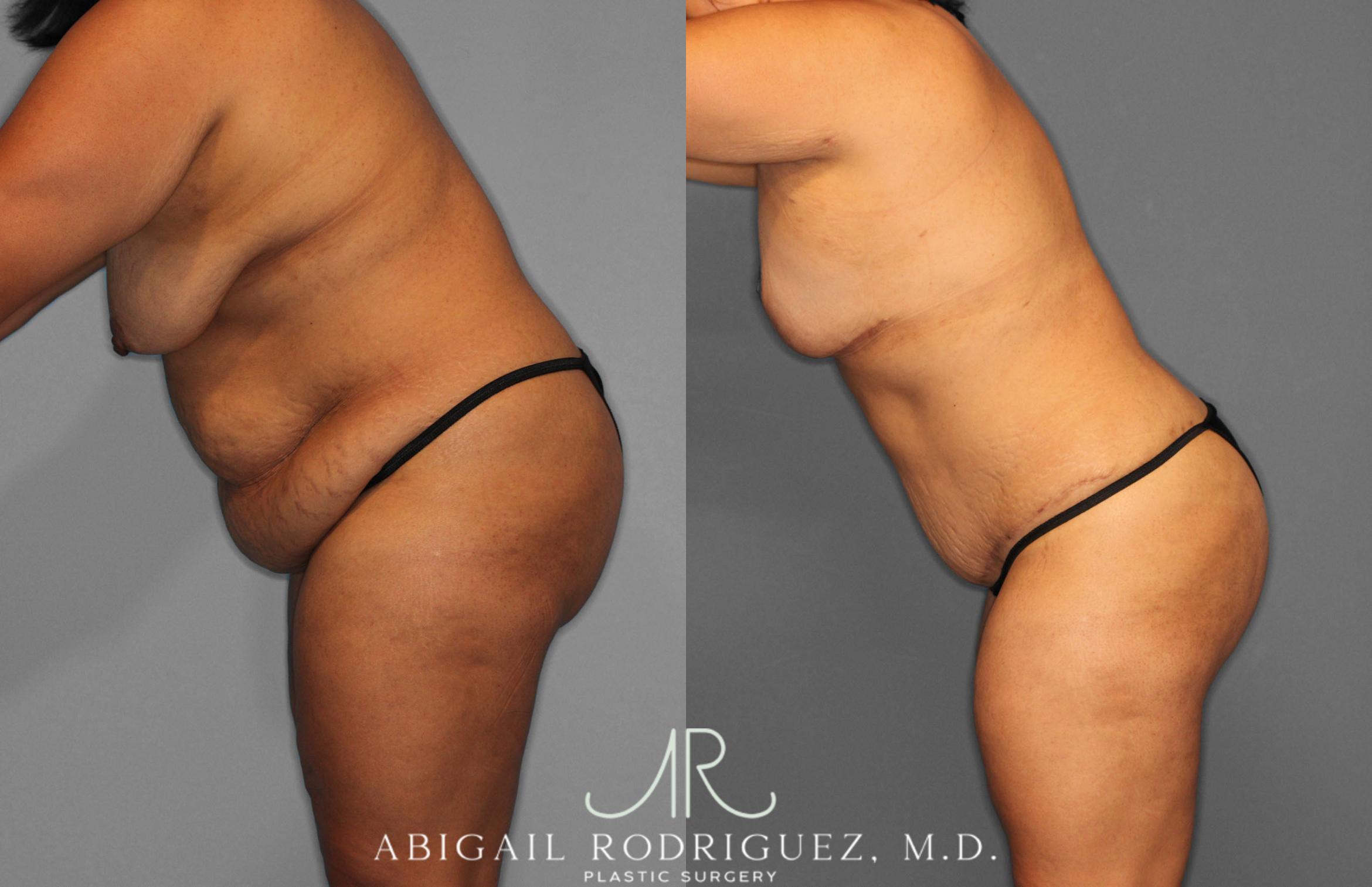 Before & After Tummy Tuck Case 257400 View 4 View in Houston, TX