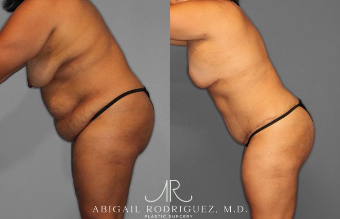 Before & After Tummy Tuck Case 257400 View 4 View in Houston, TX