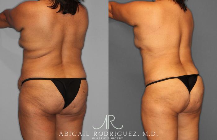 Before & After Tummy Tuck Case 257400 View 5 View in Houston, TX
