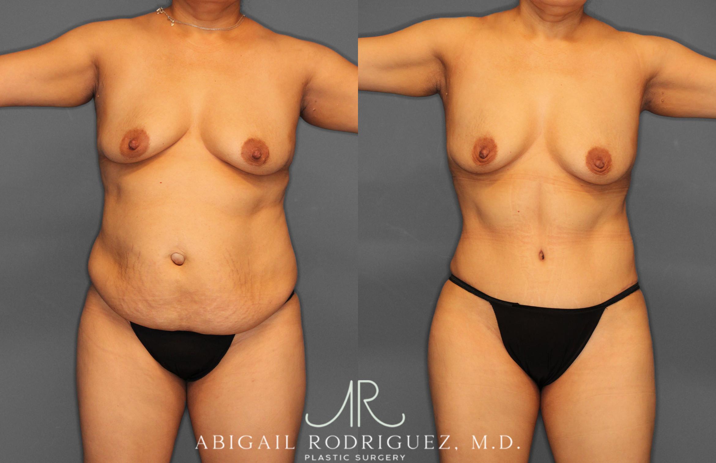 Before & After Tummy Tuck Case 257408 View 1 View in Houston, TX