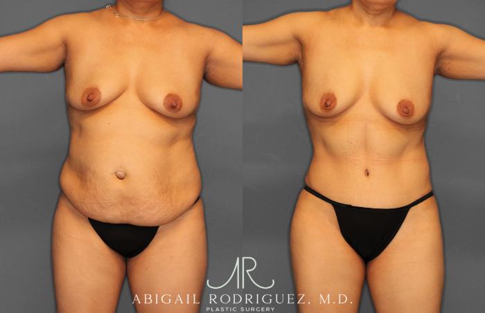 Before & After Tummy Tuck Case 257408 View 1 View in Houston, TX