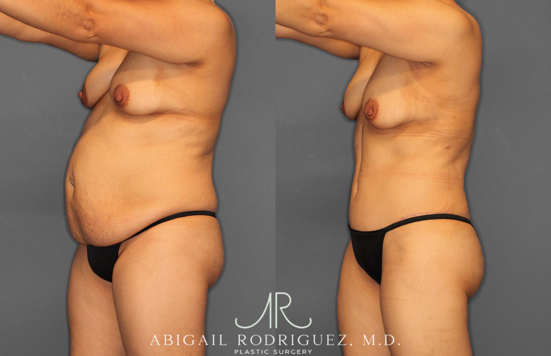 Before & After Tummy Tuck Case 257408 View 2 View in Houston, TX