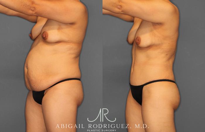 Before & After Tummy Tuck Case 257408 View 2 View in Houston, TX