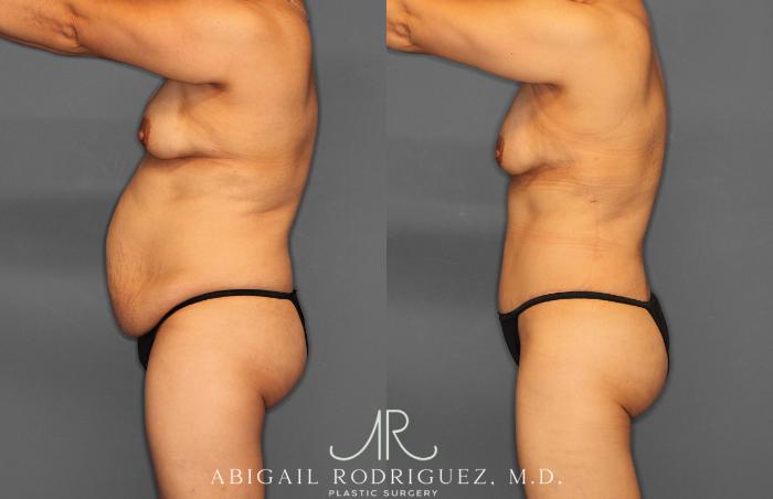 Before & After Tummy Tuck Case 257408 View 3 View in Houston, TX