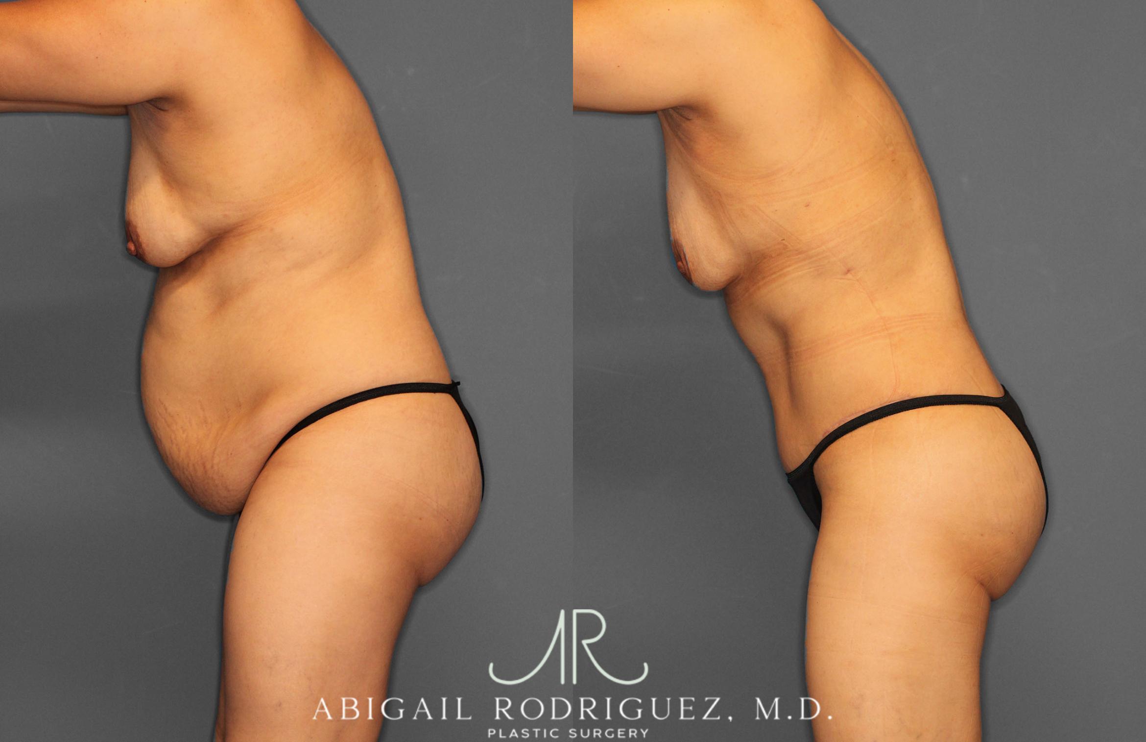 Before & After Tummy Tuck Case 257408 View 4 View in Houston, TX