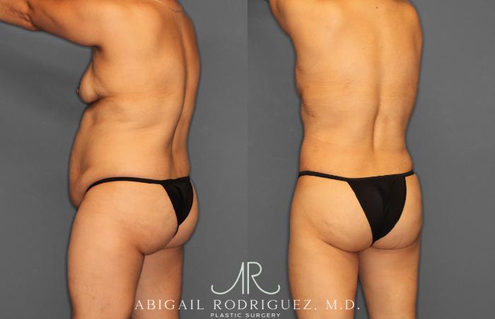 Before & After Tummy Tuck Case 257408 View 5 View in Houston, TX