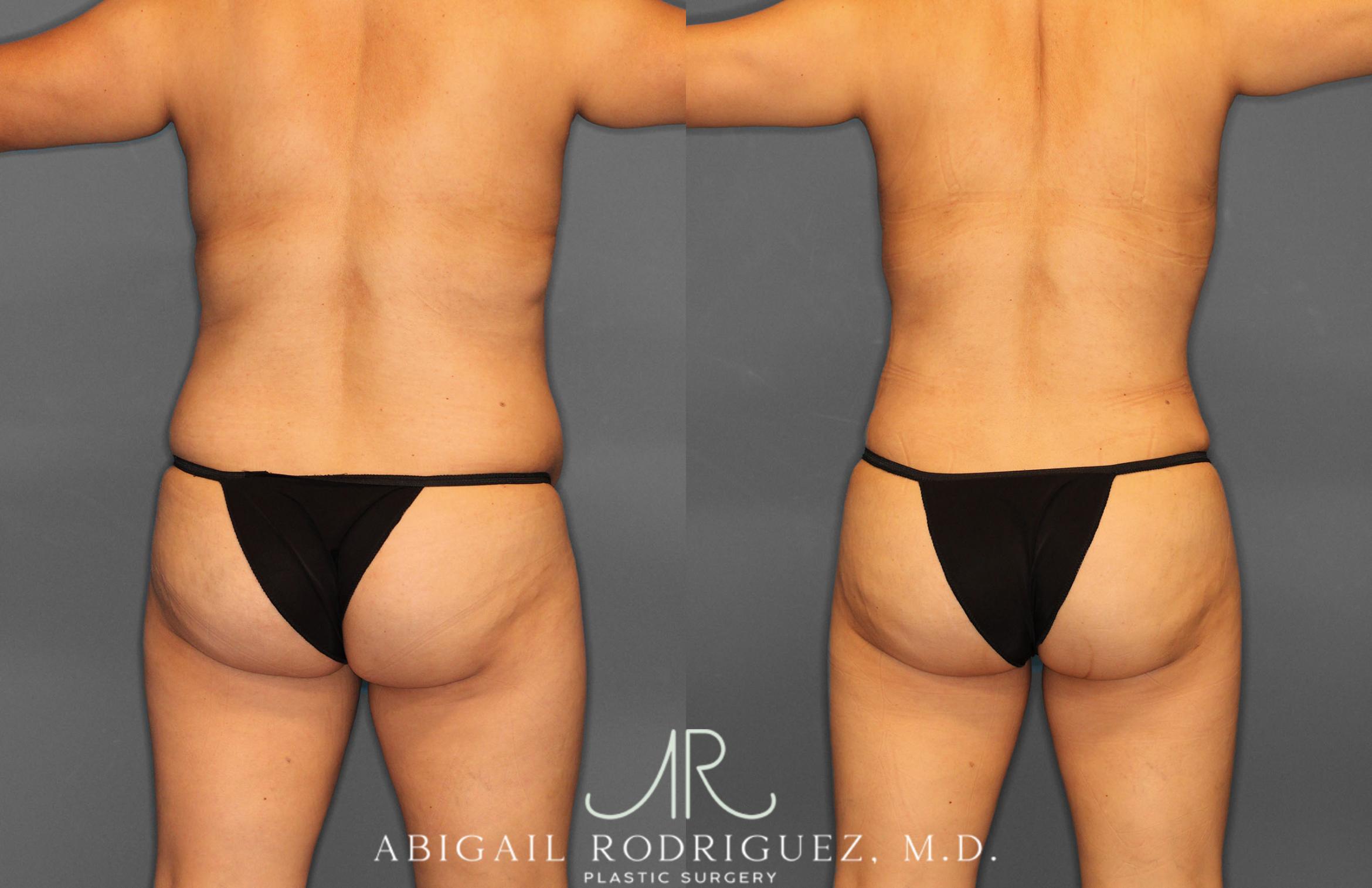 Before & After Tummy Tuck Case 257408 View 6 View in Houston, TX