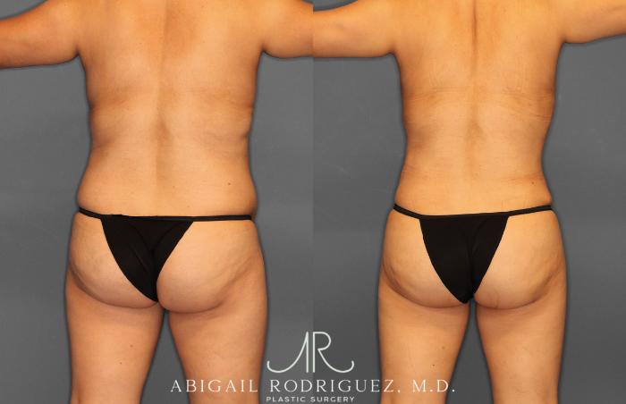 Before & After Tummy Tuck Case 257408 View 6 View in Houston, TX