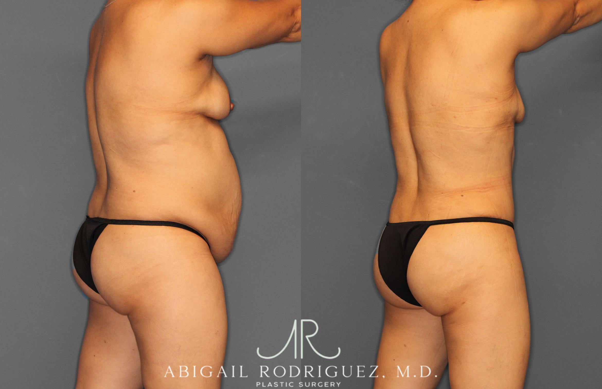Before & After Tummy Tuck Case 257408 View 7 View in Houston, TX