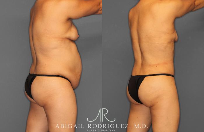 Before & After Tummy Tuck Case 257408 View 7 View in Houston, TX