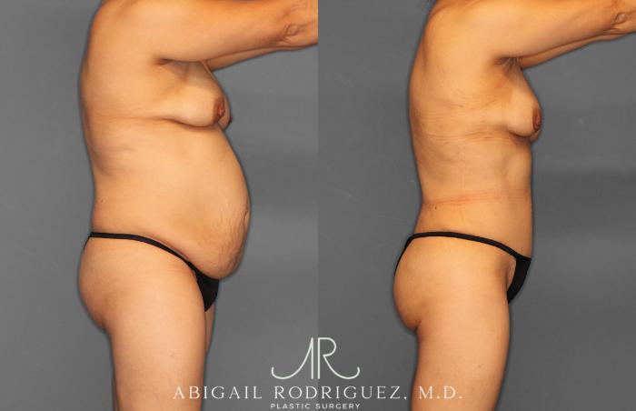 Before & After Tummy Tuck Case 257408 View 8 View in Houston, TX
