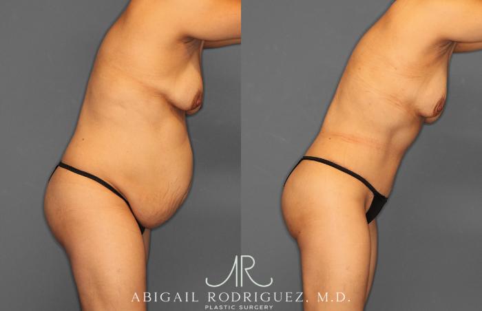 Before & After Tummy Tuck Case 257408 View 9 View in Houston, TX