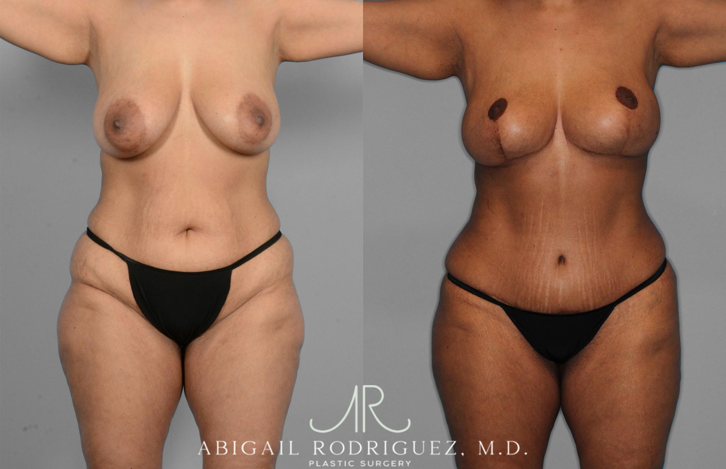 Before & After Tummy Tuck Case 257419 View 1 View in Houston, TX