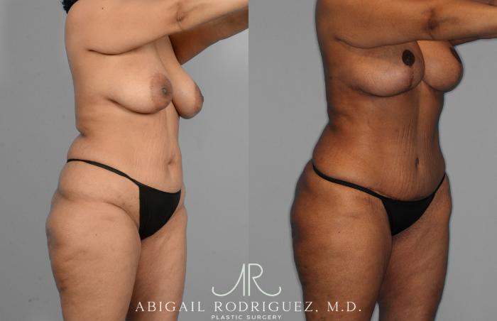 Before & After Tummy Tuck Case 257419 View 2 View in Houston, TX
