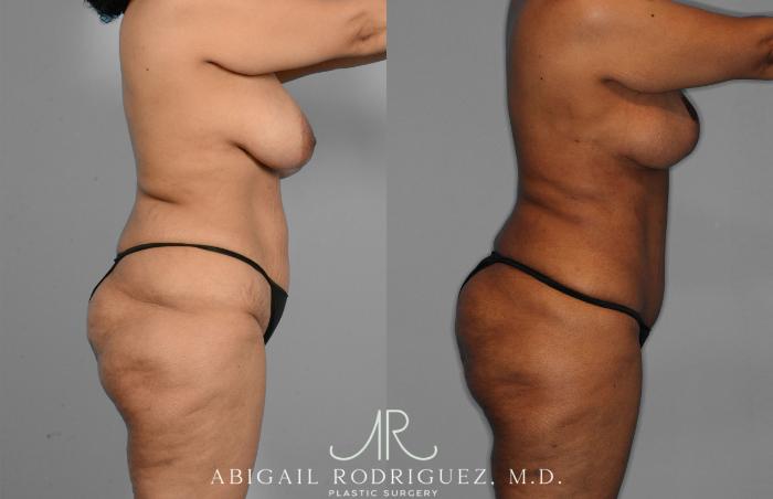 Before & After Tummy Tuck Case 257419 View 3 View in Houston, TX