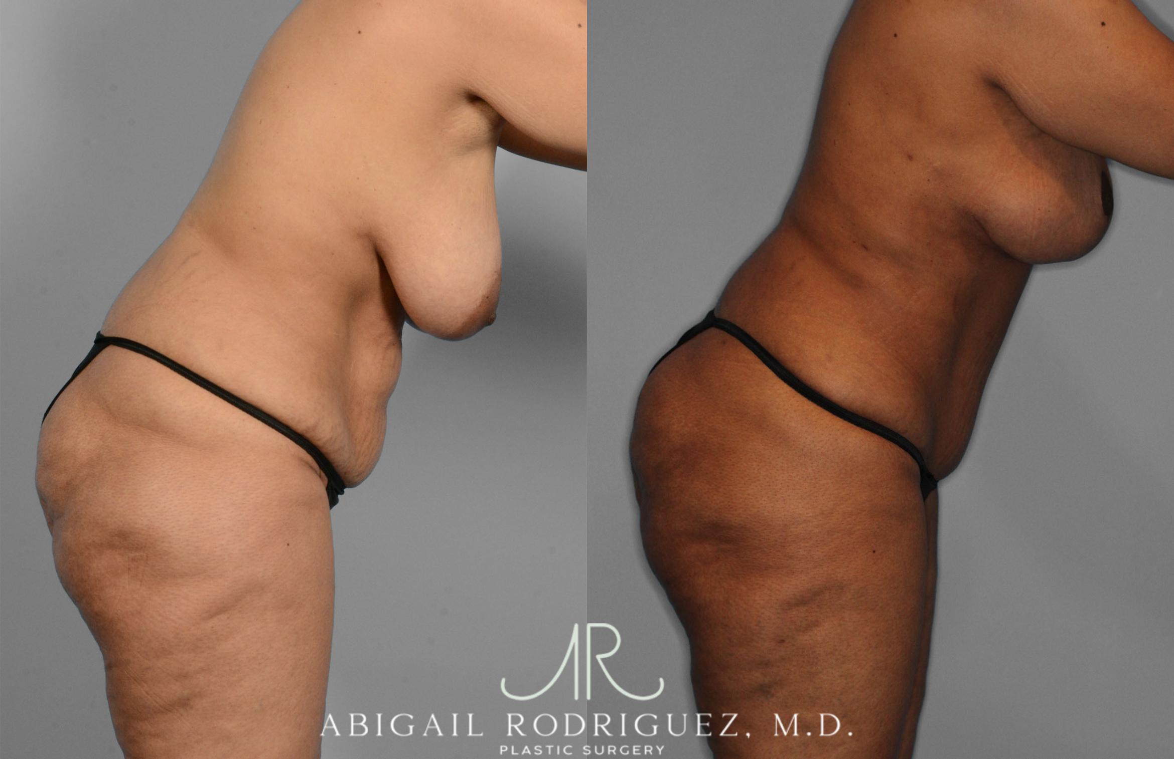 Before & After Tummy Tuck Case 257419 View 4 View in Houston, TX