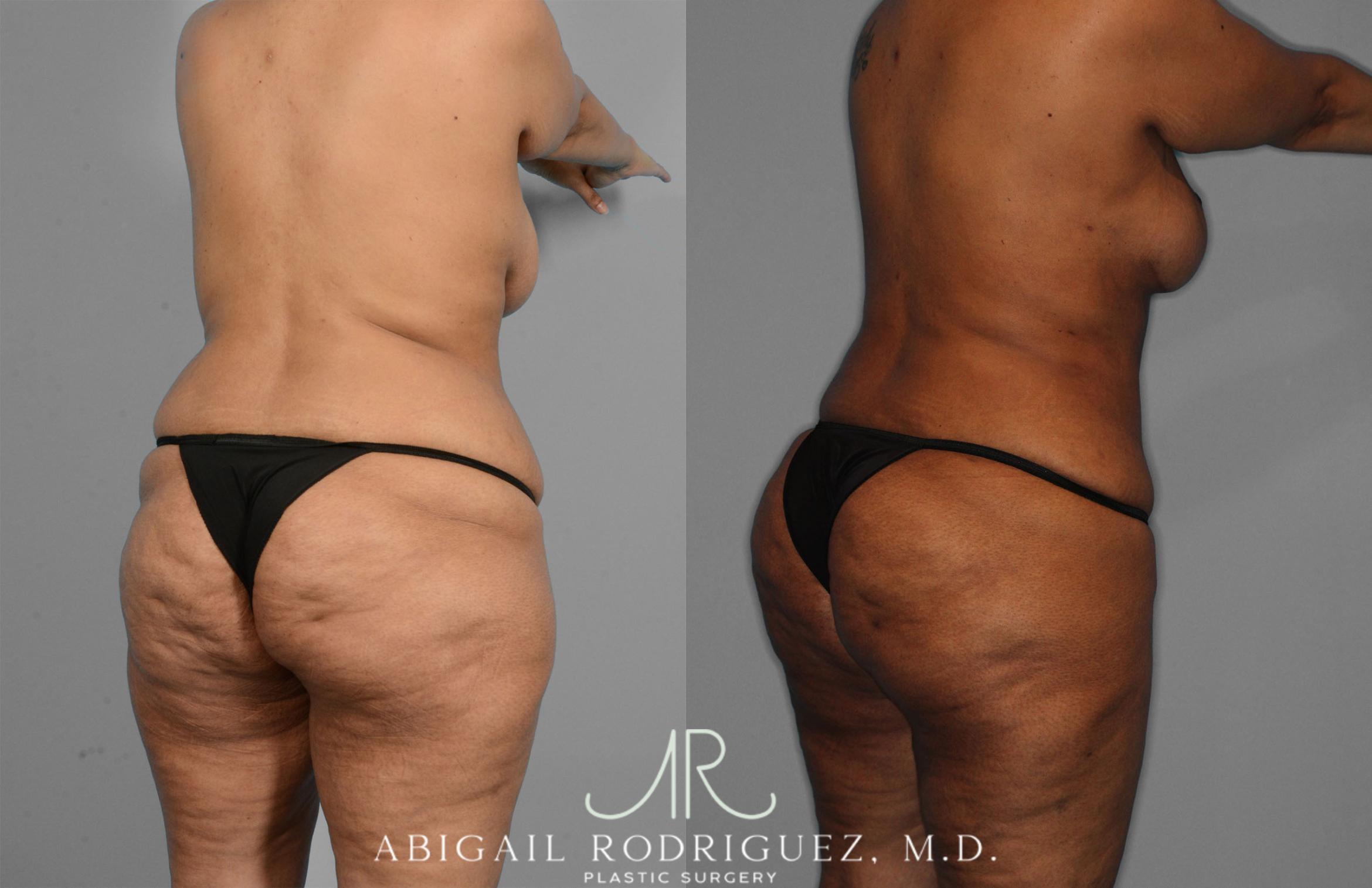 Before & After Tummy Tuck Case 257419 View 5 View in Houston, TX