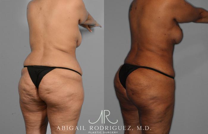 Before & After Tummy Tuck Case 257419 View 5 View in Houston, TX