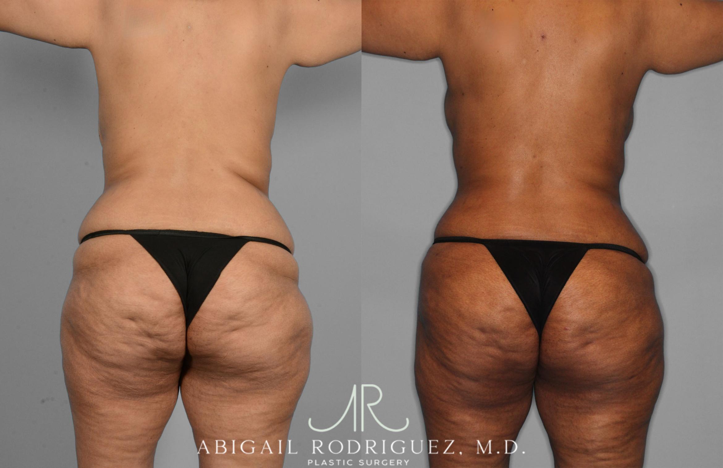 Before & After Tummy Tuck Case 257419 View 6 View in Houston, TX