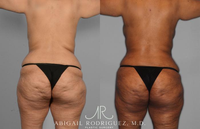 Before & After Tummy Tuck Case 257419 View 6 View in Houston, TX
