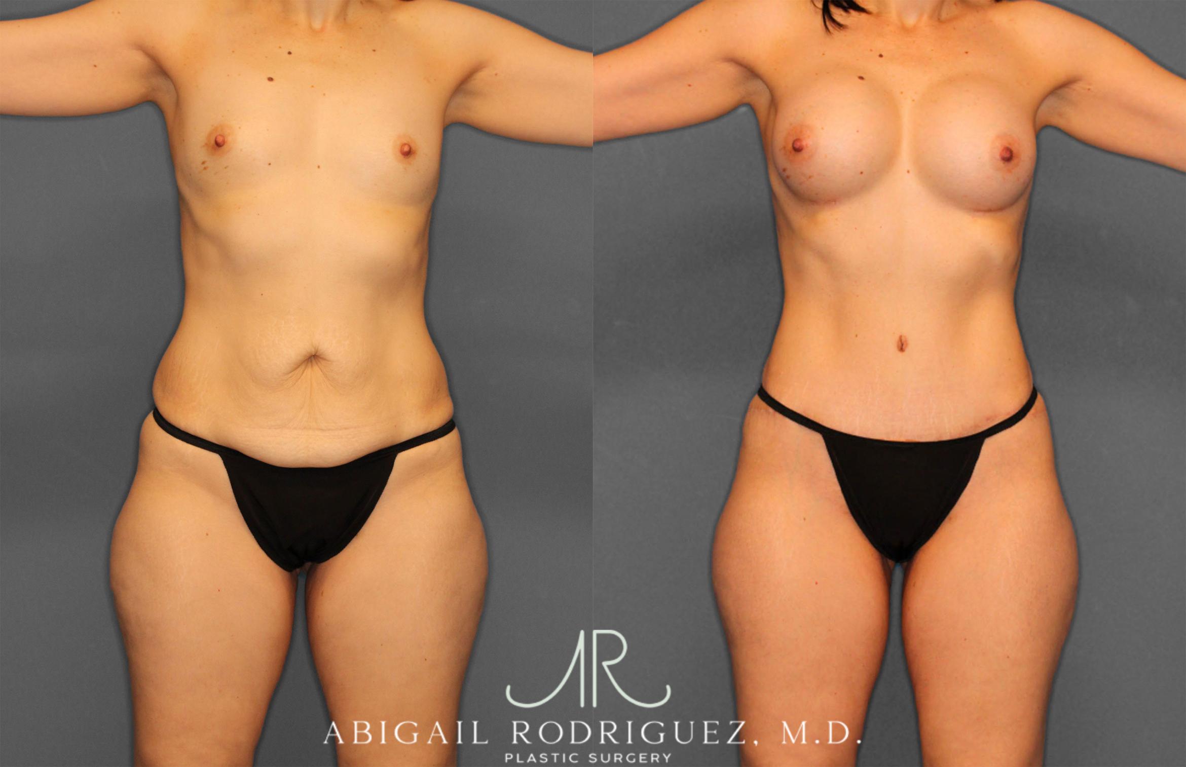 Before & After Tummy Tuck Case 257442 View 1 View in Houston, TX