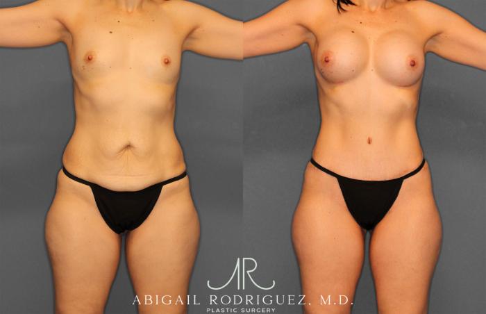 Before & After Tummy Tuck Case 257442 View 1 View in Houston, TX