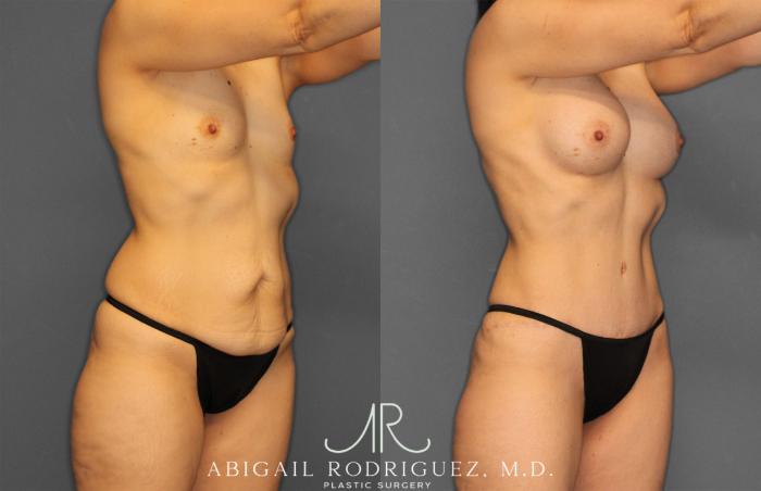 Before & After Tummy Tuck Case 257442 View 10 View in Houston, TX