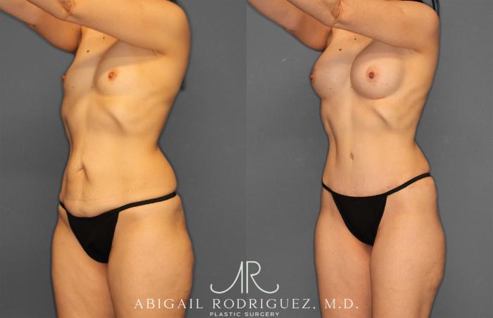 Before & After Tummy Tuck Case 257442 View 2 View in Houston, TX