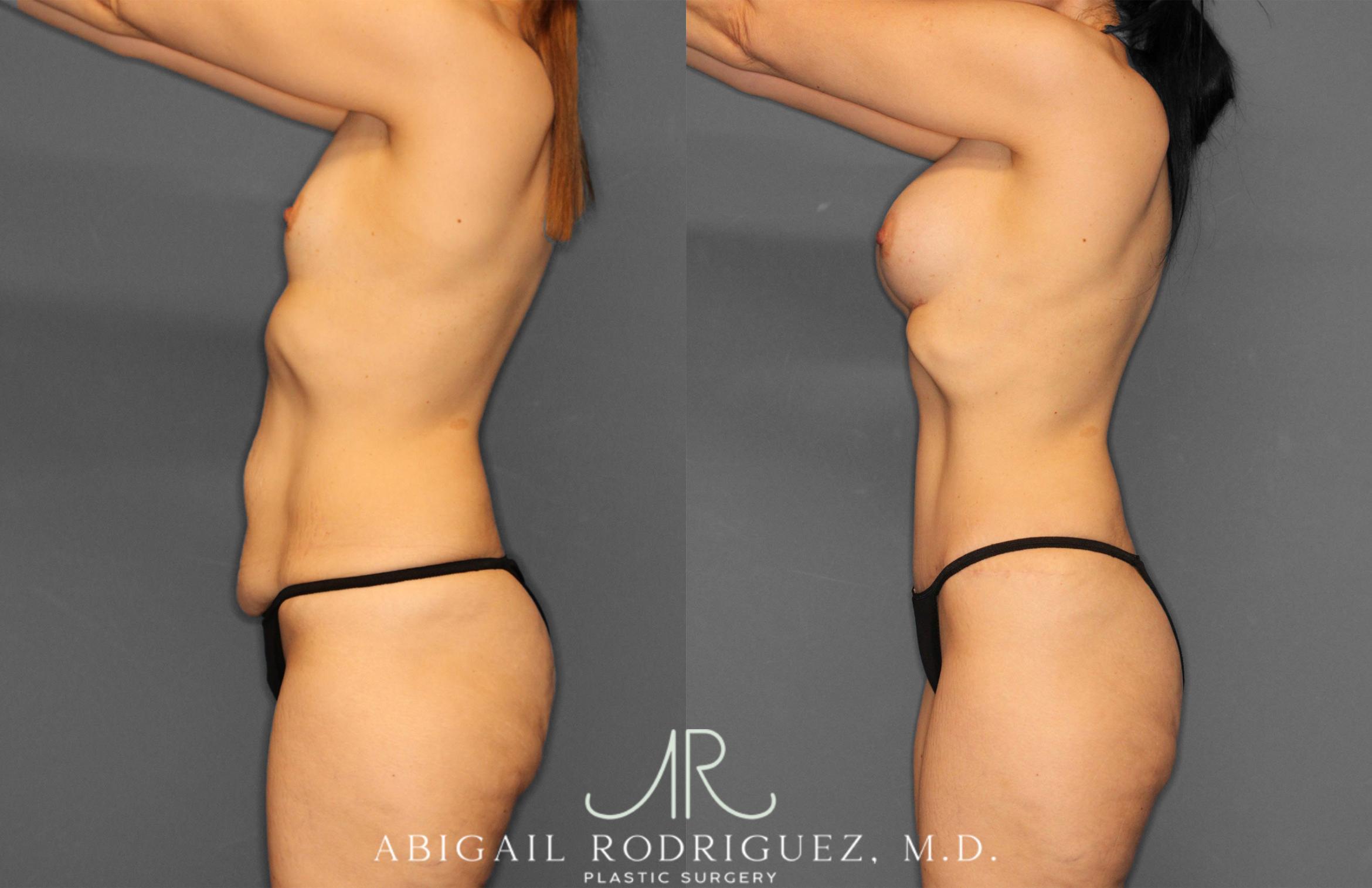 Before & After Tummy Tuck Case 257442 View 3 View in Houston, TX