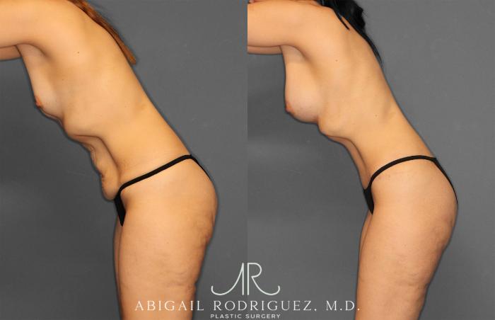 Before & After Tummy Tuck Case 257442 View 4 View in Houston, TX