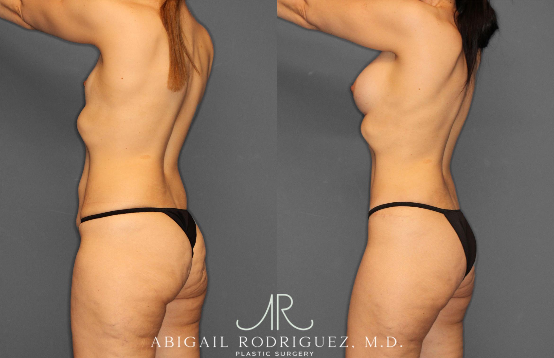 Before & After Tummy Tuck Case 257442 View 5 View in Houston, TX