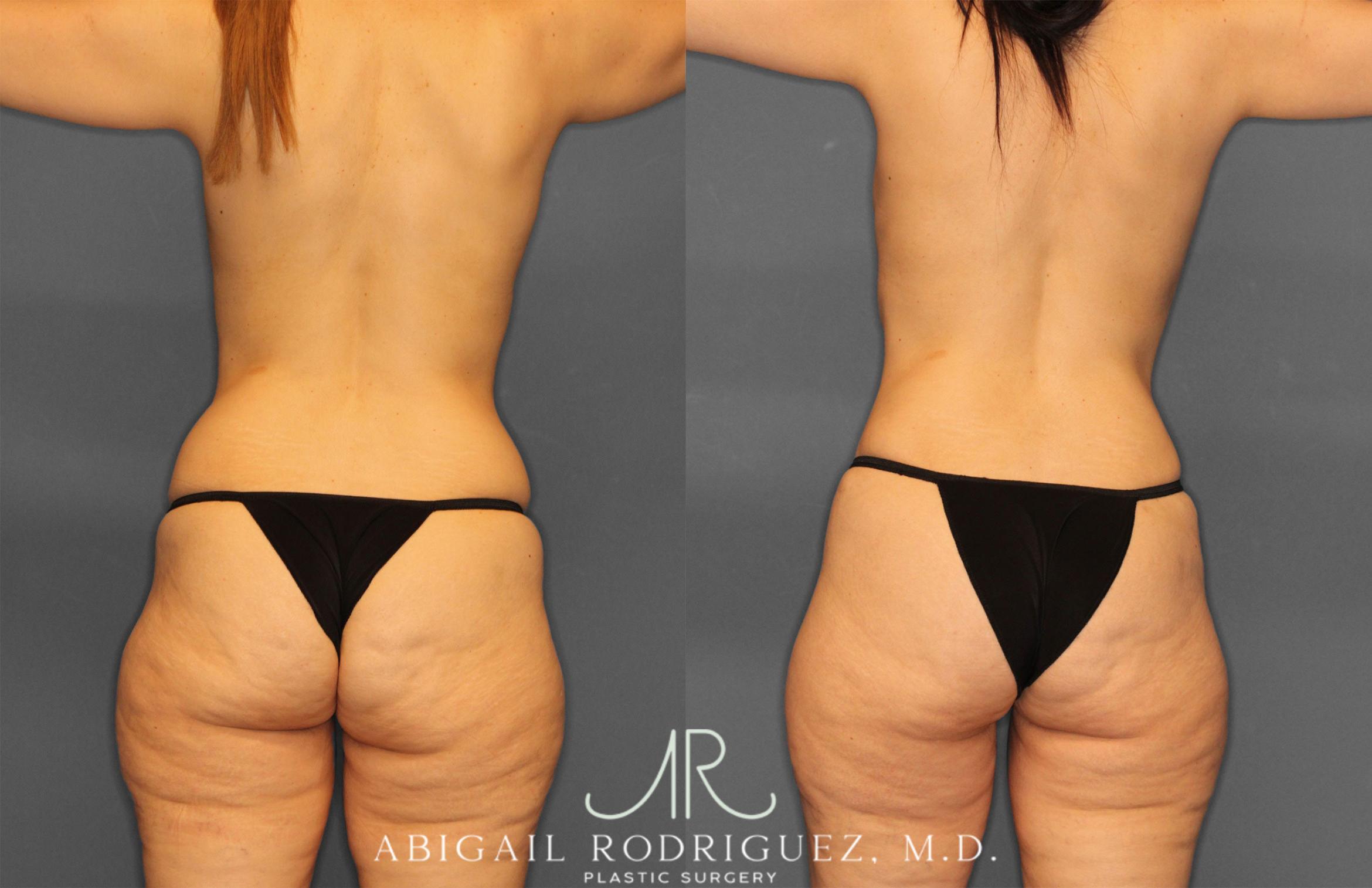 Before & After Tummy Tuck Case 257442 View 6 View in Houston, TX