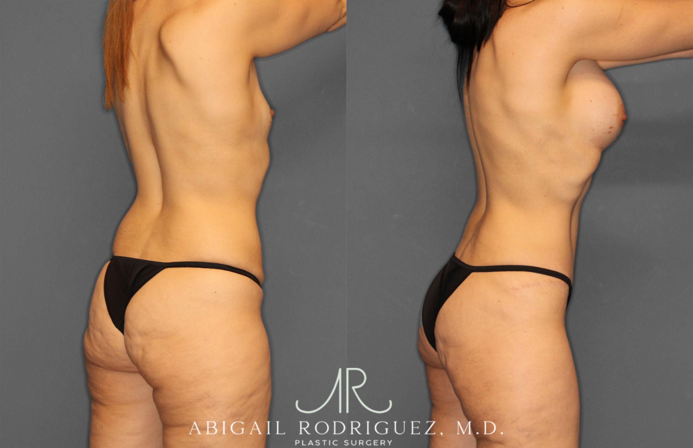 Before & After Tummy Tuck Case 257442 View 7 View in Houston, TX
