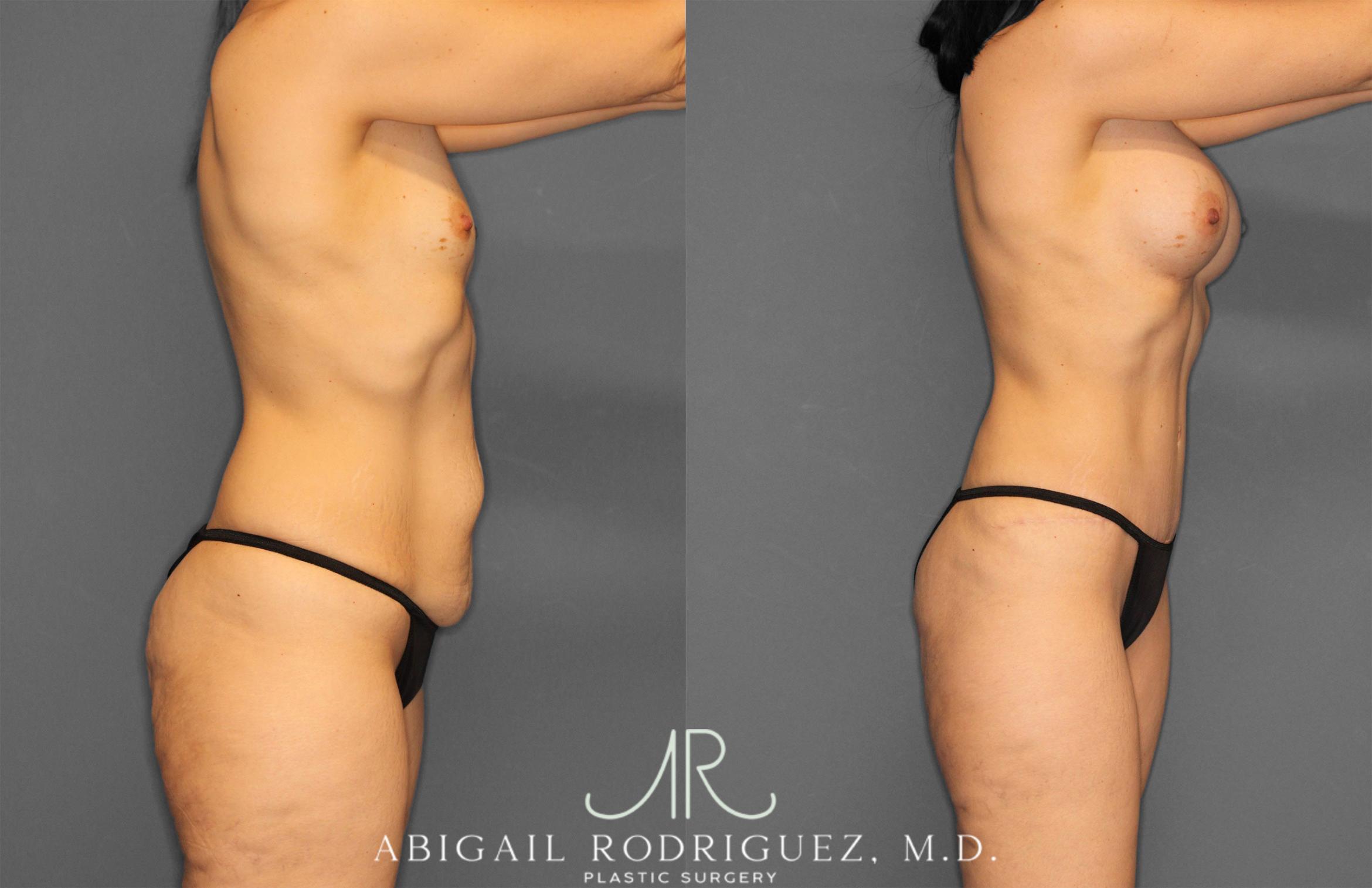 Before & After Tummy Tuck Case 257442 View 8 View in Houston, TX
