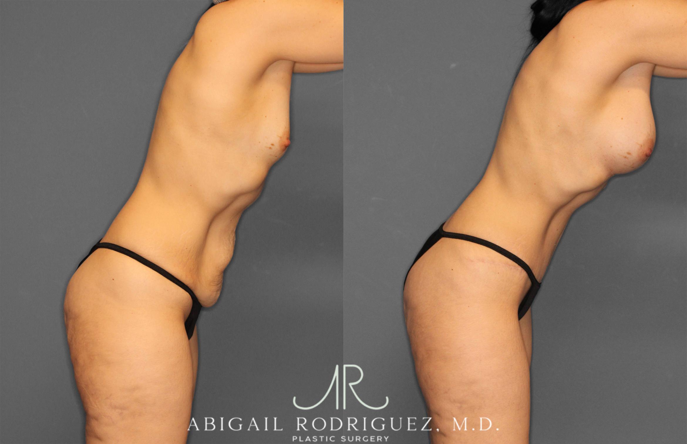 Before & After Tummy Tuck Case 257442 View 9 View in Houston, TX
