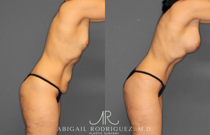 Before & After Tummy Tuck Case 257442 View 9 View in Houston, TX
