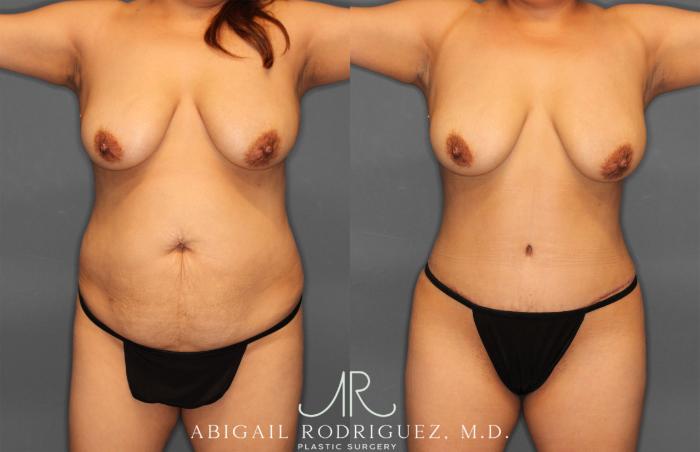 Before & After Tummy Tuck Case 257464 View 1 View in Houston, TX