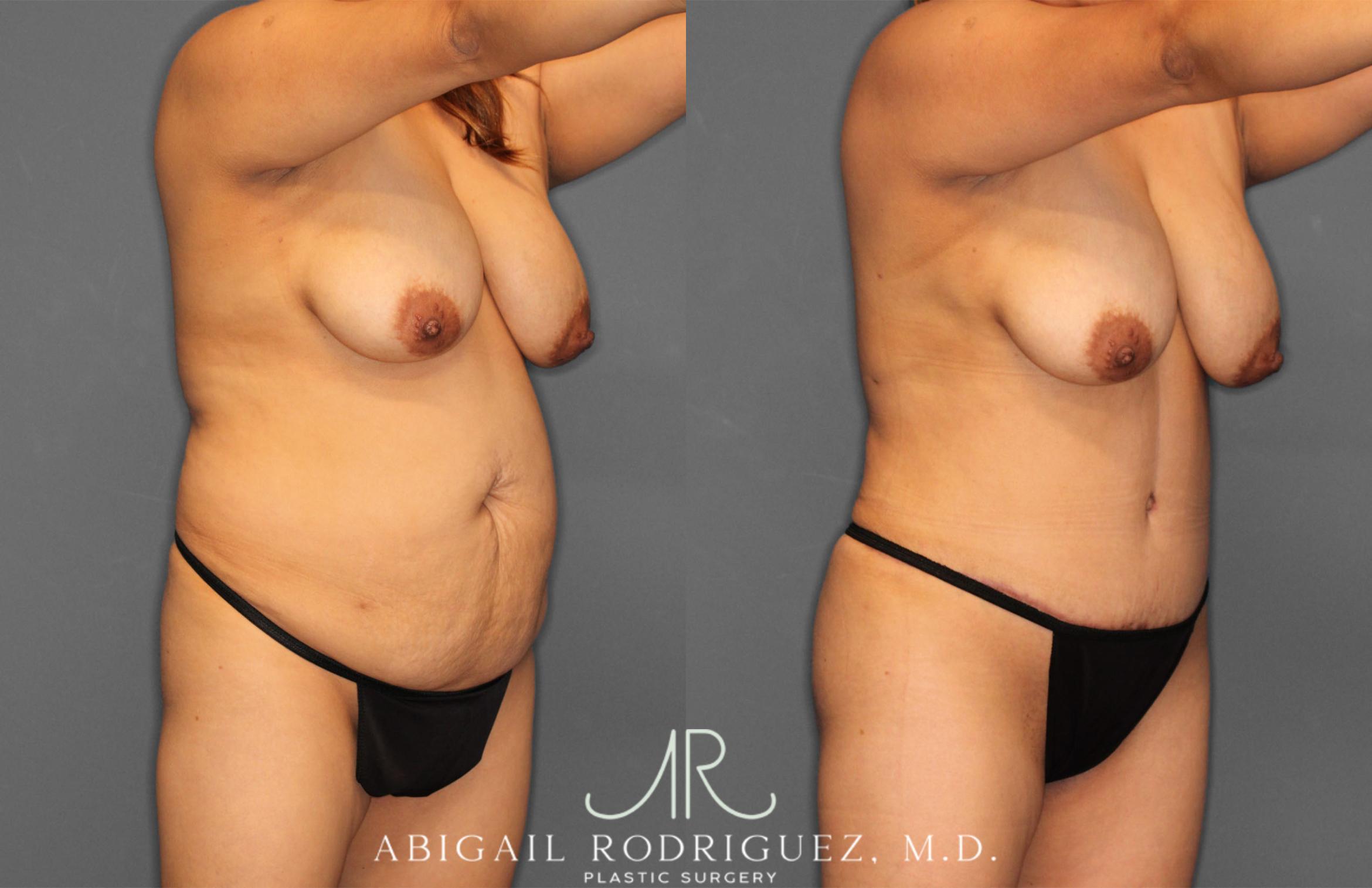 Before & After Tummy Tuck Case 257464 View 10 View in Houston, TX