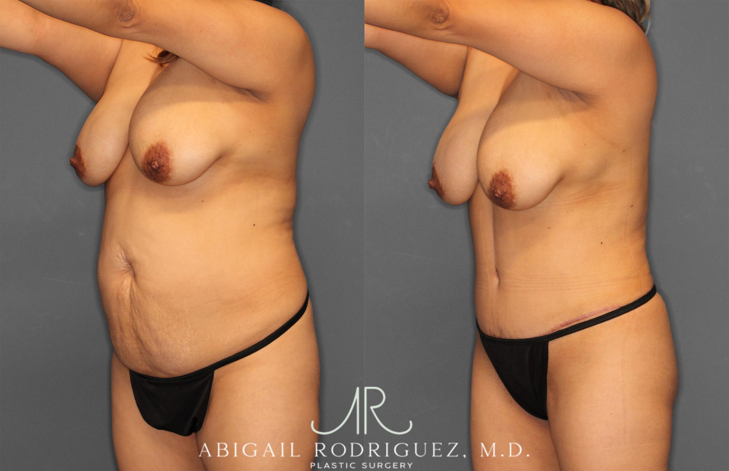 Before & After Tummy Tuck Case 257464 View 2 View in Houston, TX