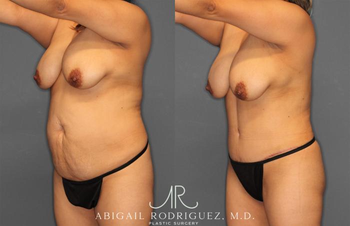 Before & After Tummy Tuck Case 257464 View 2 View in Houston, TX