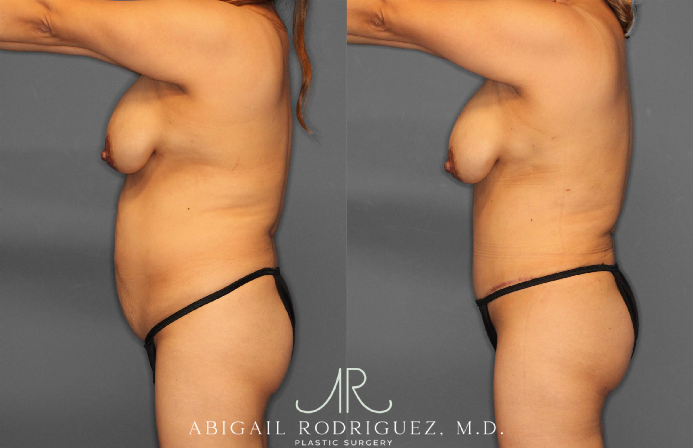 Before & After Tummy Tuck Case 257464 View 3 View in Houston, TX