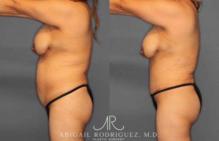 Before & After Tummy Tuck Case 257464 View 3 View in Houston, TX