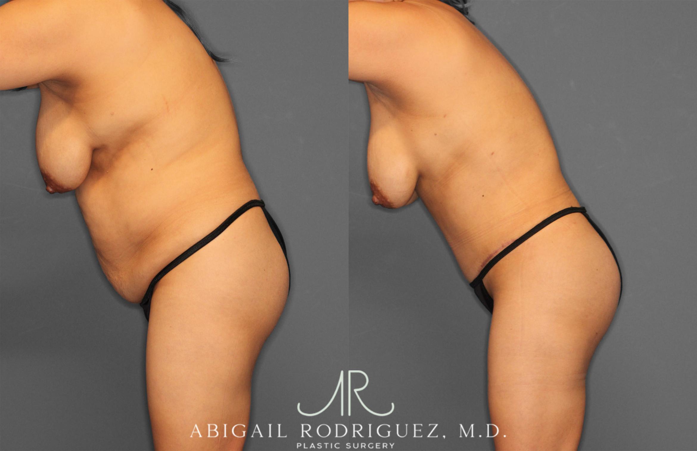 Before & After Tummy Tuck Case 257464 View 4 View in Houston, TX