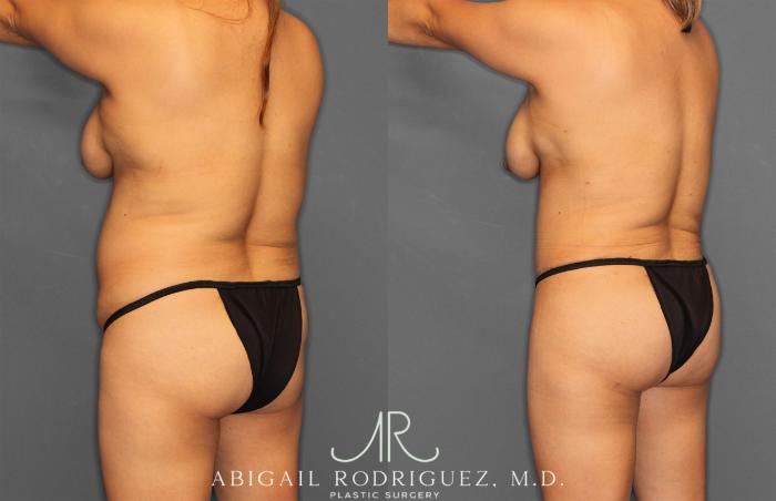 Before & After Tummy Tuck Case 257464 View 5 View in Houston, TX
