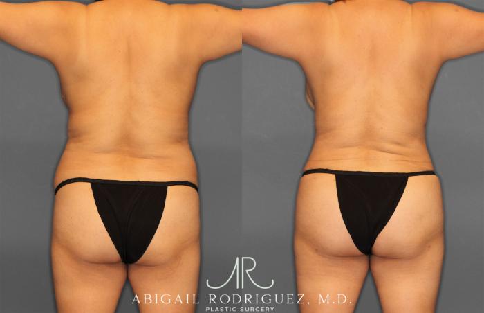 Before & After Tummy Tuck Case 257464 View 6 View in Houston, TX