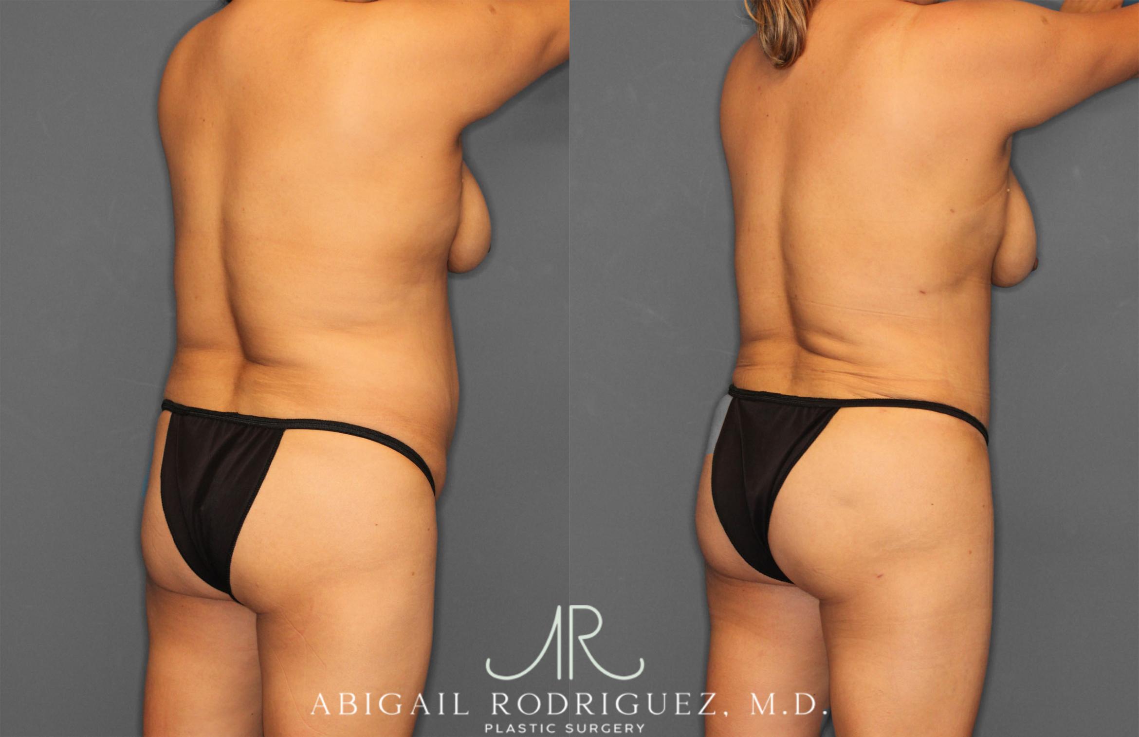 Before & After Tummy Tuck Case 257464 View 7 View in Houston, TX